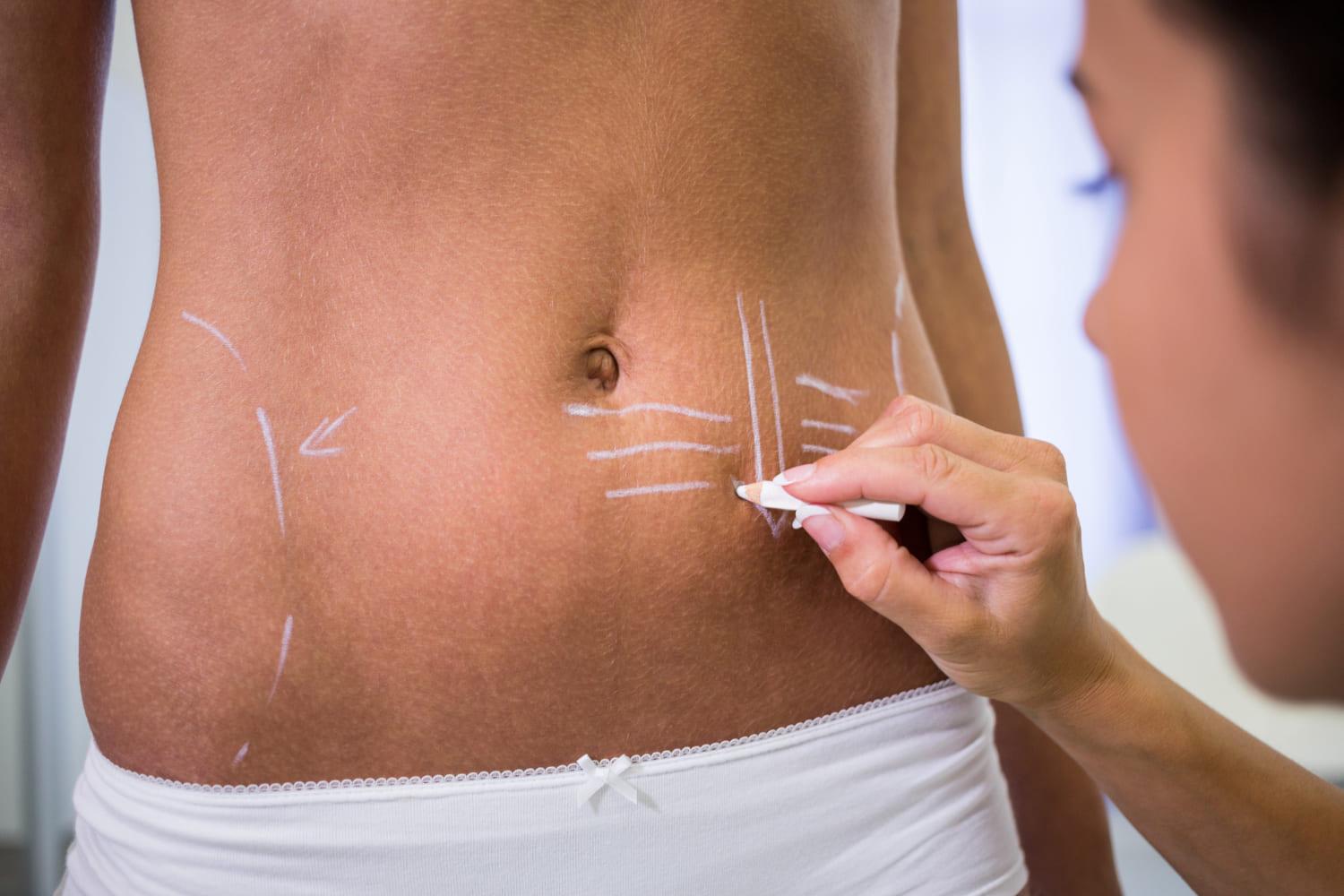 Surgeon marking a patient's abdomen before liposuction