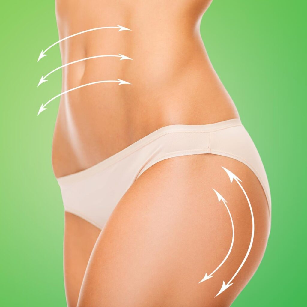Body-contouring arrows illustrating liposuction target areas on the abdomen and hips