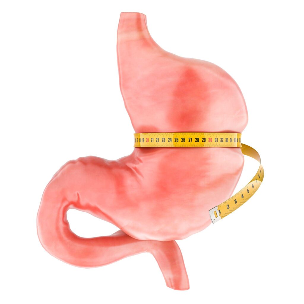 Anatomical stomach model wrapped in a tape measure, illustrating a stretched gastric sleeve and weight regain