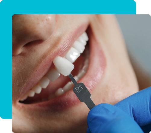 Group 5 24 Dental Veneers in Turkey