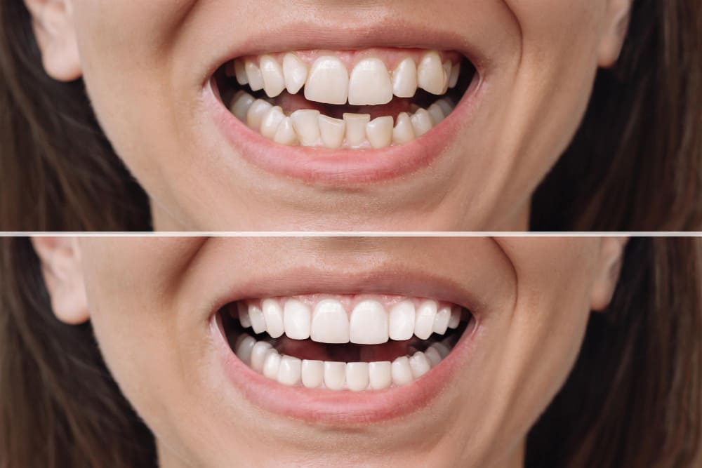Veneers Cost Full Mouth: What You’ll Really Pay in 2025 9 Full Mouth Veneers Cost before and after