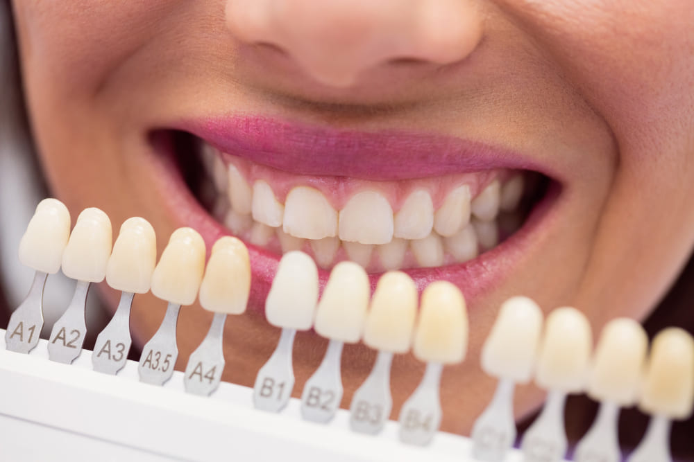 How to Choose the Right Types of Dental Veneers For You 31 Types of dental veneers