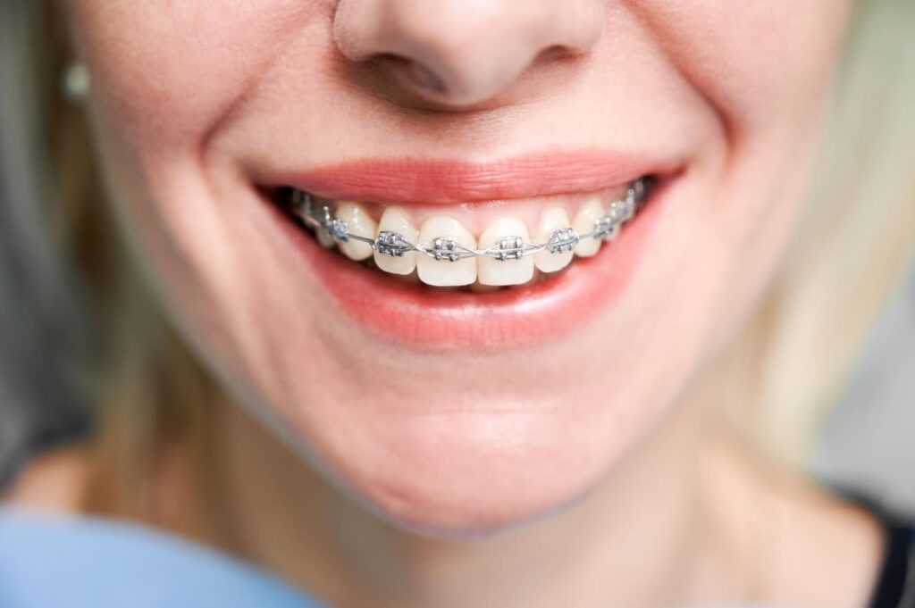 Swollen Gums with Braces? Here’s How to Soothe and Heal Fast 1 Close-up of smiling woman wearing metal braces showing healthy gums and teeth