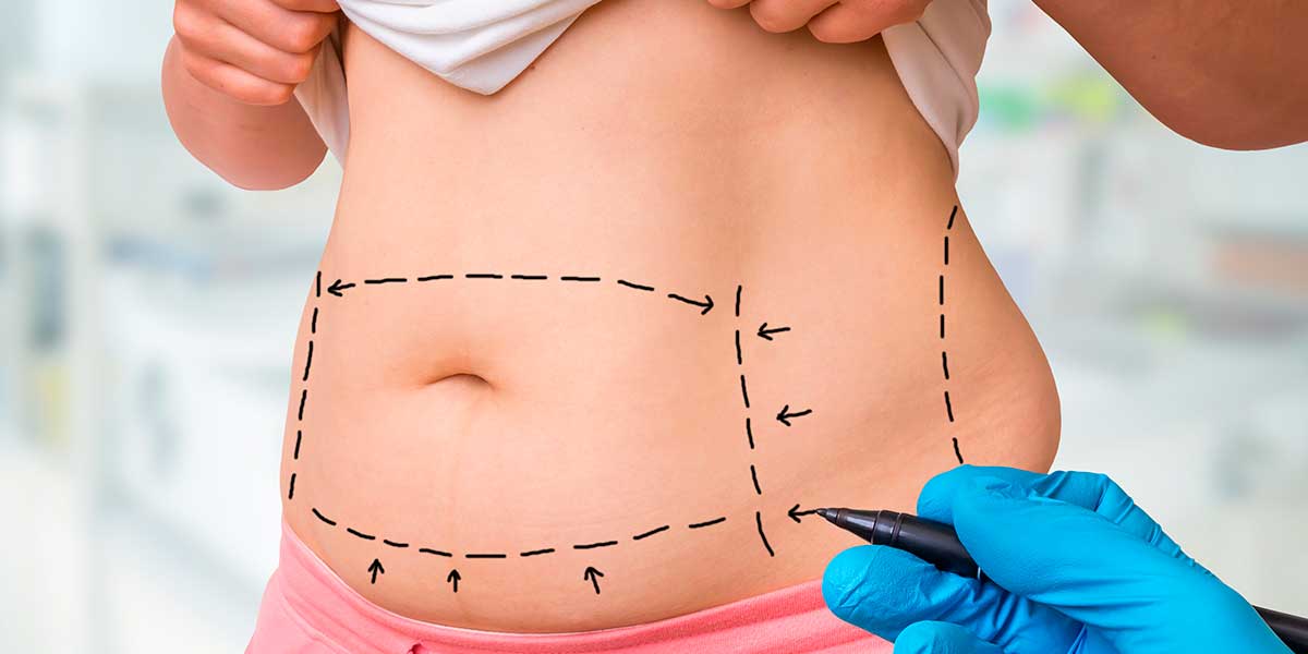 liposuction