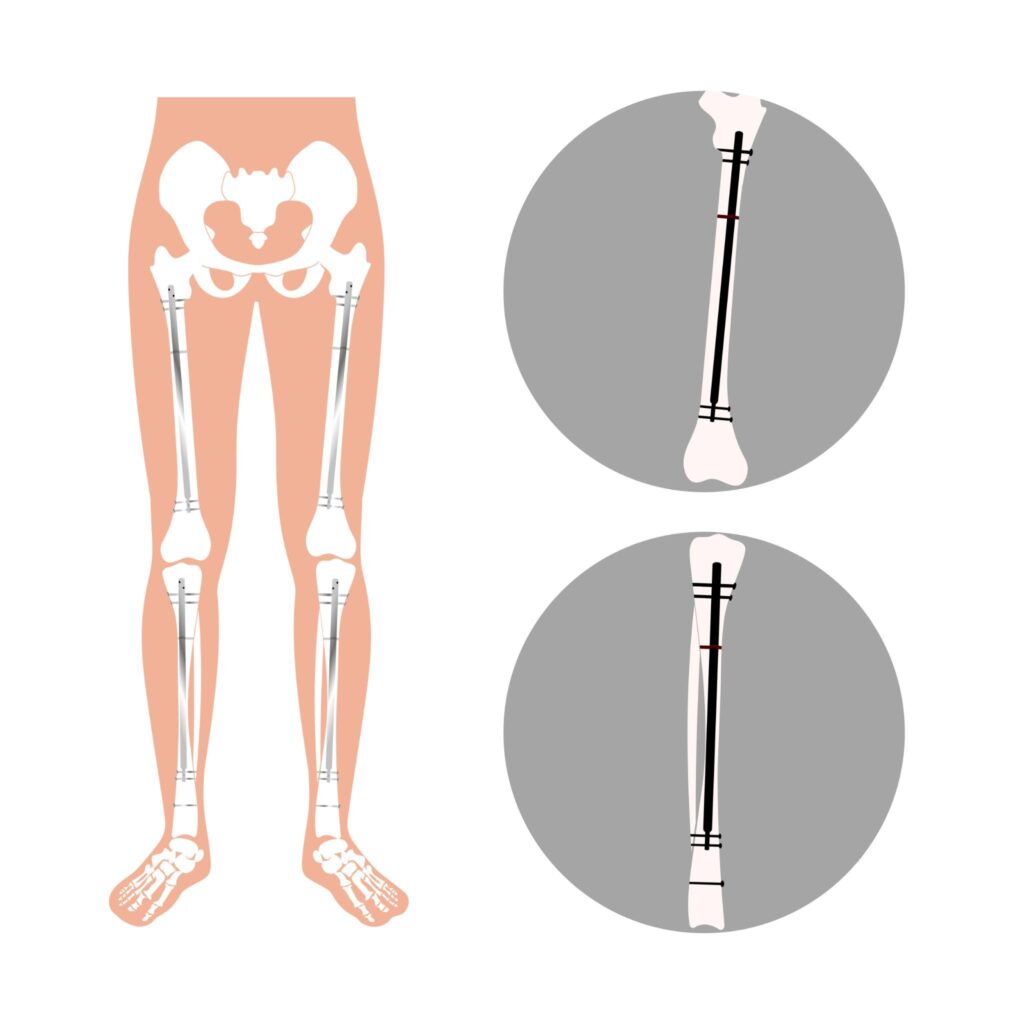 Possible complications of limb lengthening surgery and what “gone wrong” means