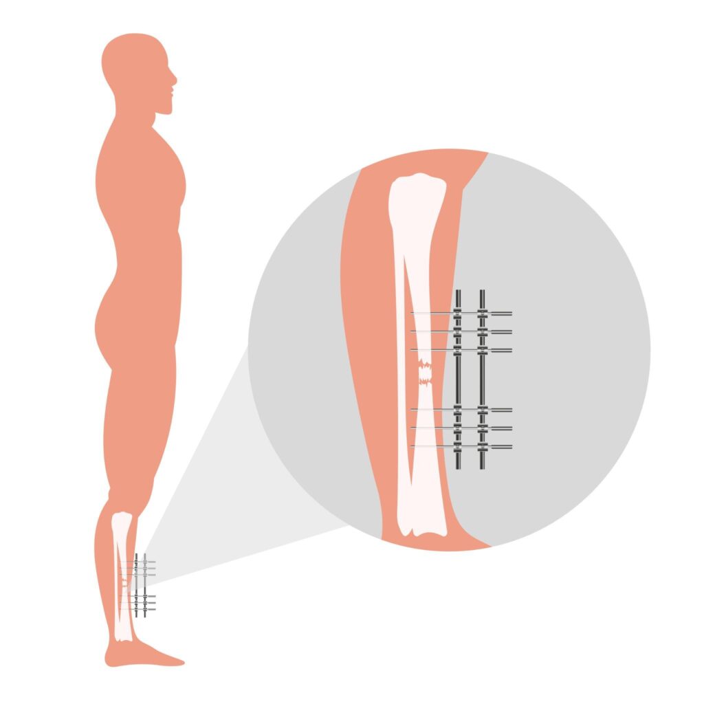 Understanding the risks of limb lengthening surgery abroad